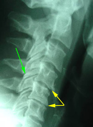 disc degeneration treated at Pure Chiropractic