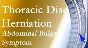 Pure Chiropractic cares for thoracic disc herniation that for some patients prompts abdominal pain.