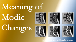 Pure Chiropractic sees many back pain and neck pain patients who bring their MRIs with them to the office. Modic changes are often seen. 