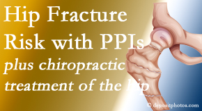 Pure Chiropractic shares new research describing higher risk of hip fracture with proton pump inhibitor use. 