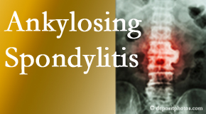 Ankylosing spondylitis is gently cared for by your Concord, NC chiropractor.