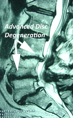 disc degeneration late