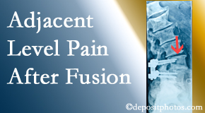 Pure Chiropractic offers relieving care non-surgically to back pain patients suffering with adjacent level pain after spinal fusion surgery.