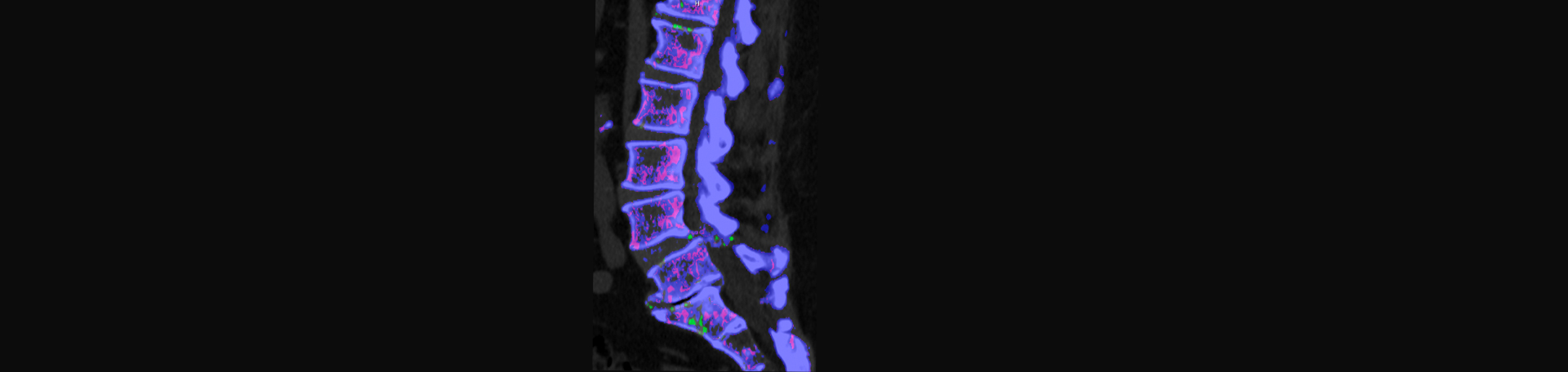 Pure Chiropractic is aware that inflammatory spinal gout is a differential diagnosis to consider for patients who present with back pain and other spine related symptoms.