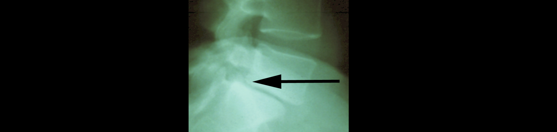 Concord, NC spondylolisthesis 