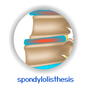 image of Concord, NC chiropractic spondylolisthesis