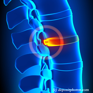 image of lumbar Concord, NC disc herniation