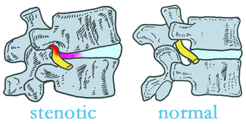 Concord, NC stenotic and normal spinal discs